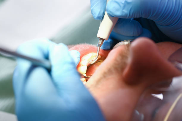 Best Emergency Tooth Extraction in Woodbury, NY